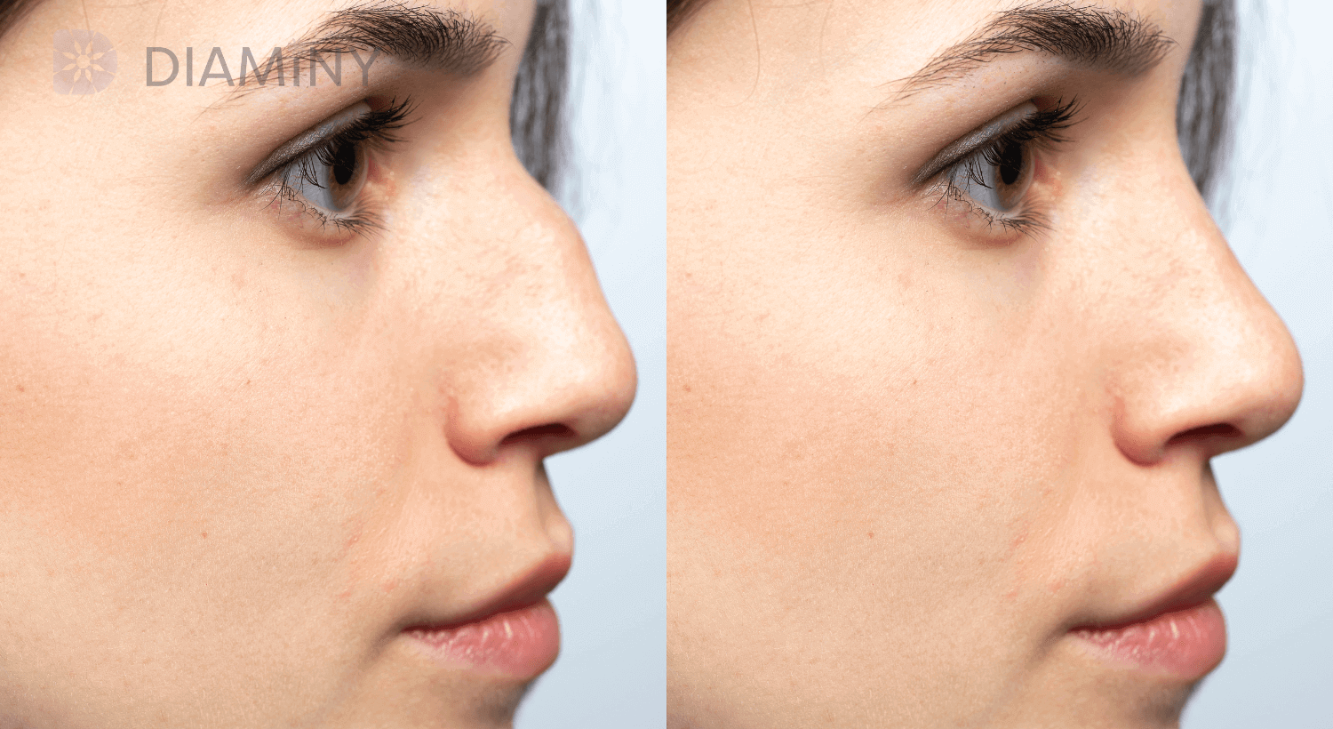 nose filler injection before and after