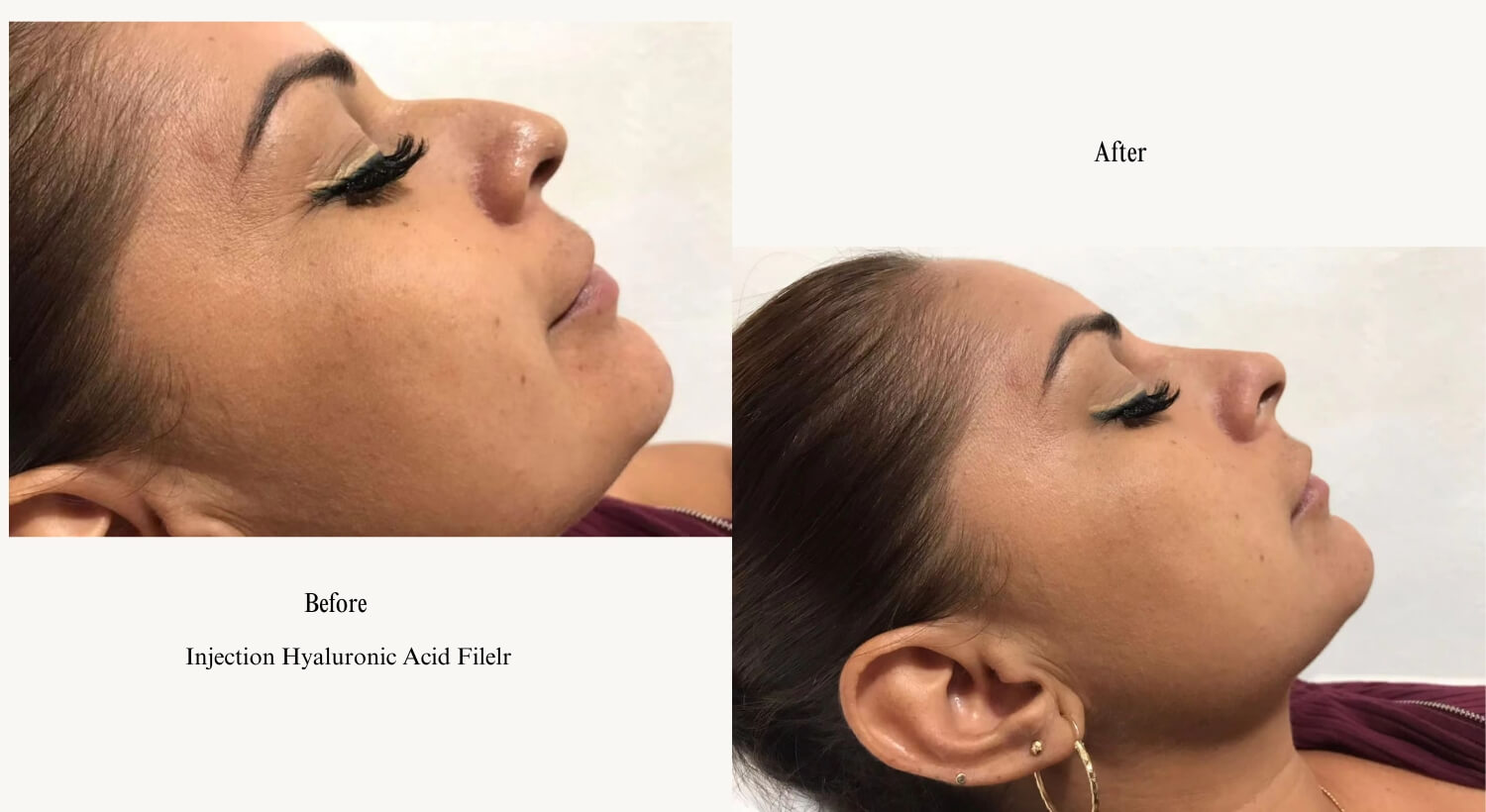 Non-Surgical Nose Jobs Before After