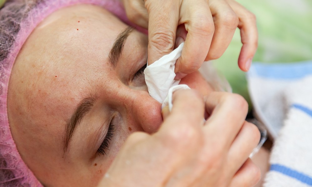 swelling after nose thread lifts