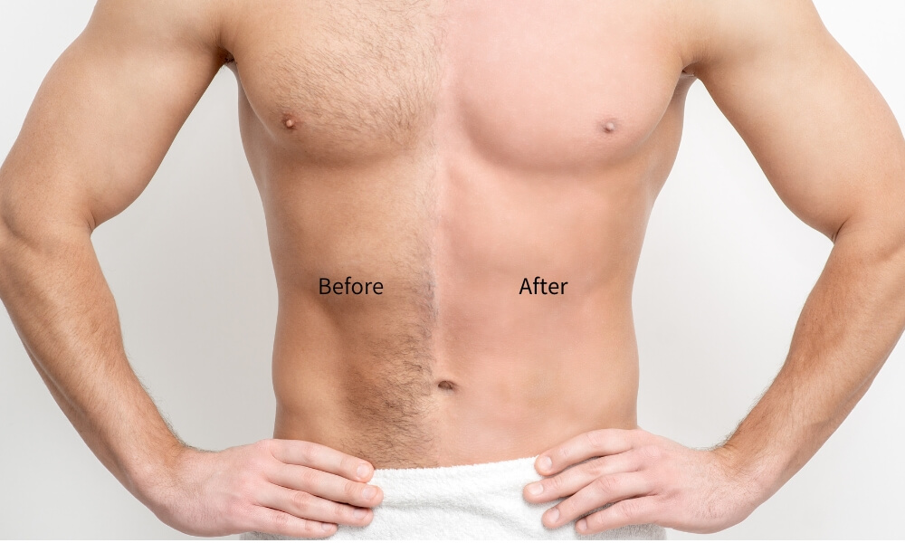 What are the Benefits of IPL hair removal