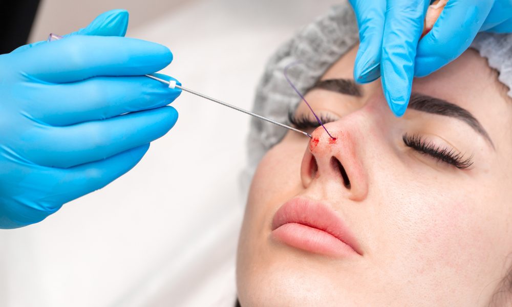 Diaminy nose thread lift