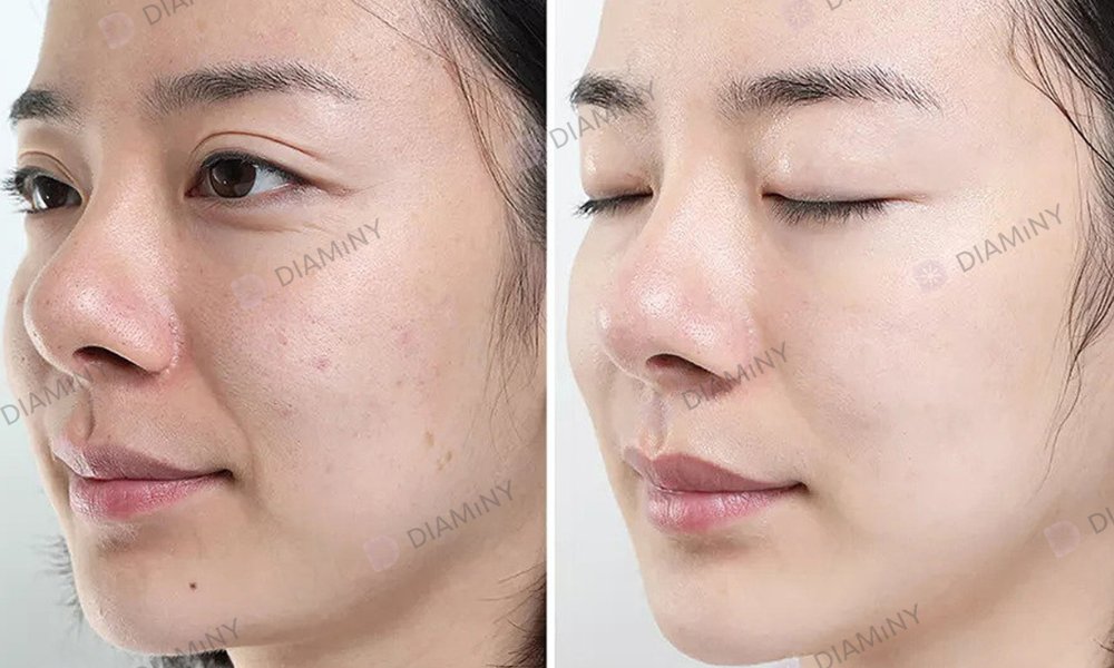 reduce wrinkles with hydra needle