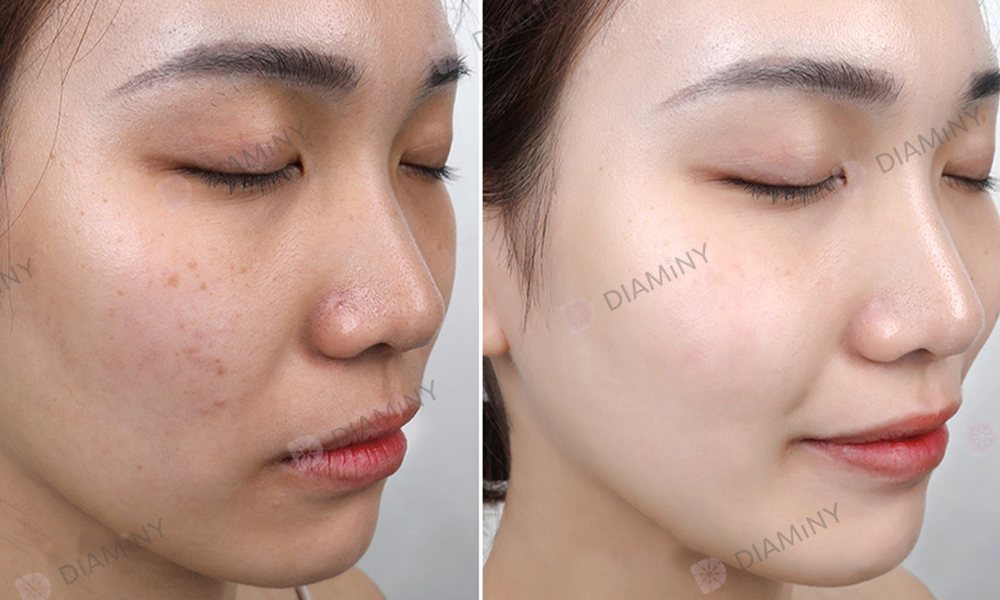 skin glow with hydra needle