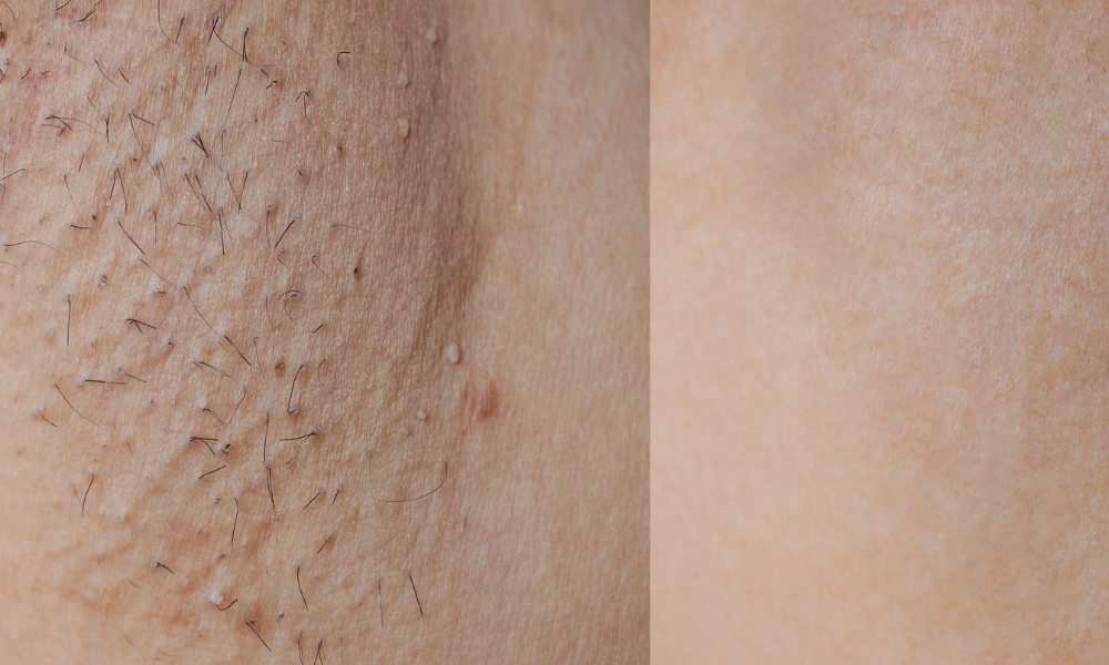 Laser Hair Removal Devices At Home