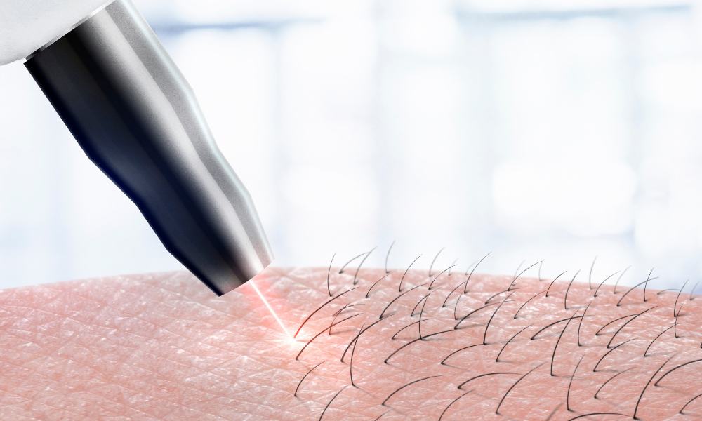 Laser Hair Removal Adverse Reactions