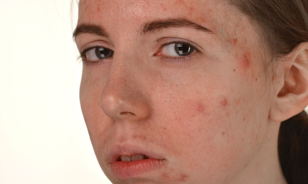 side effects of hydra needling