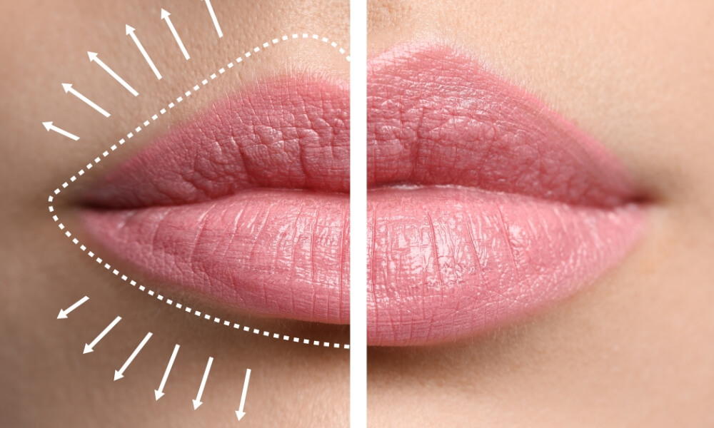 Lip Enhancement with cannula