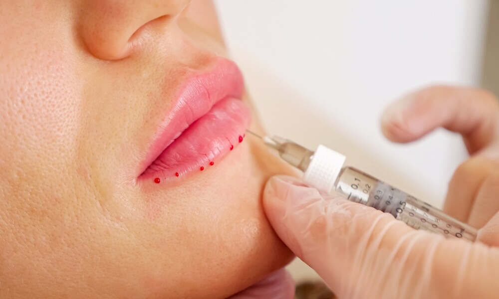 Recovery Time like for both Lip Filler Cannulas and Needles