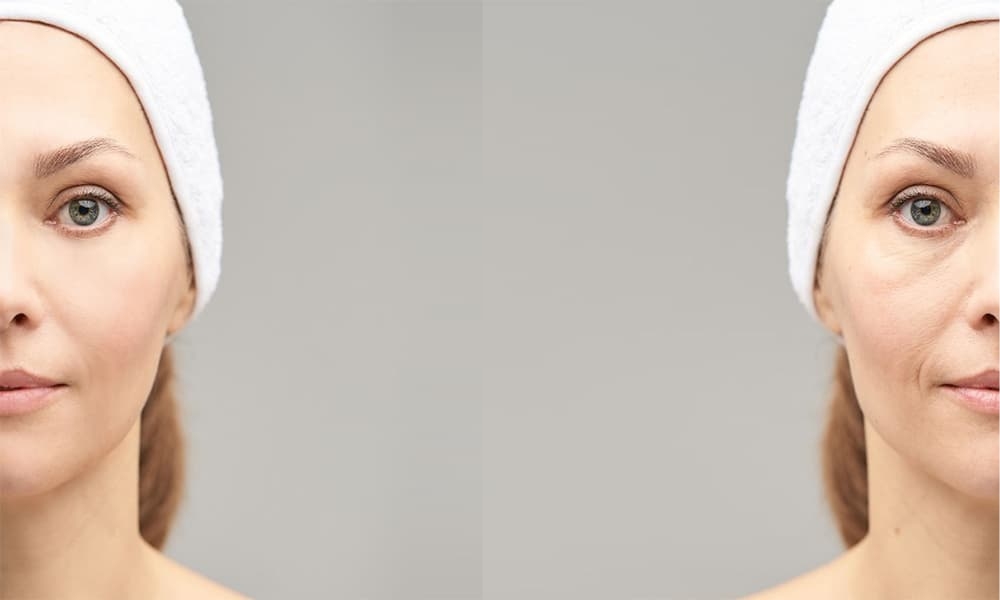Can Fillers Help with Under Eye Bags 
