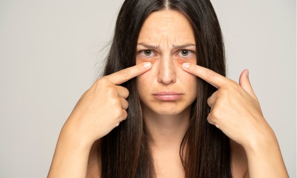 What leads to under-eye bags