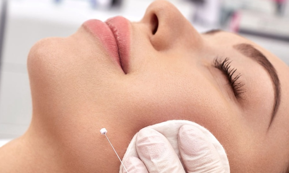 Result and Expectations of the Thread Facelift Procedure