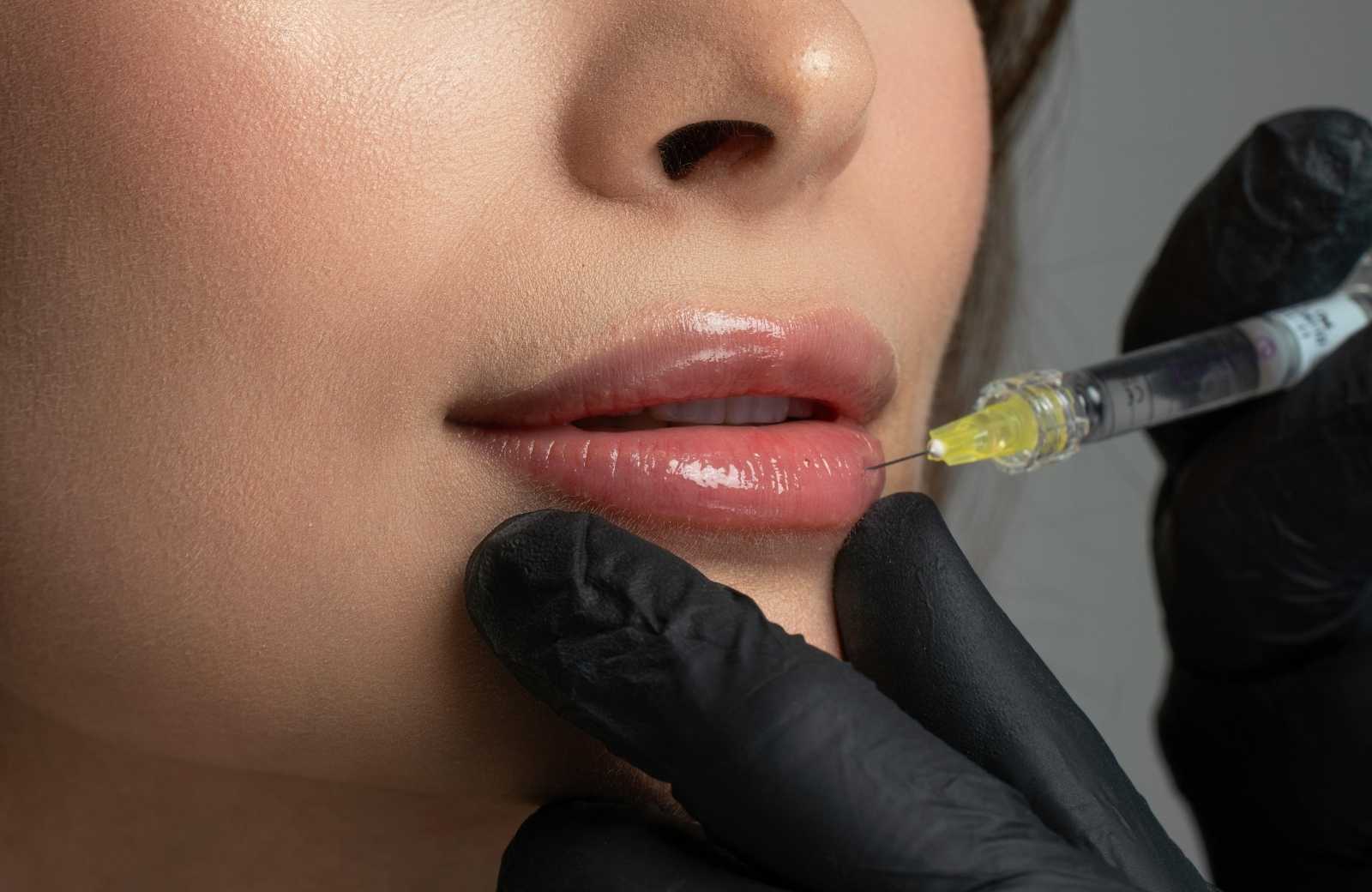 30G Mesoneedle for Lip Filler