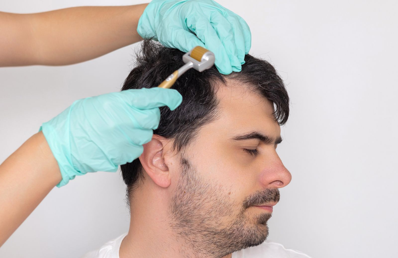 Best Dermaroller for Hair Loss