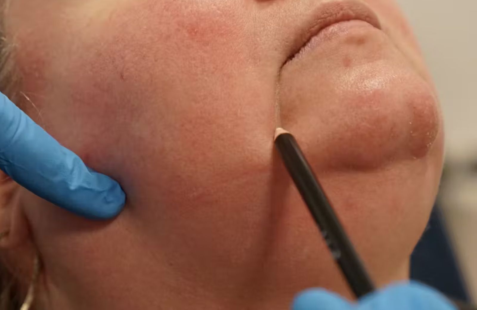 Marionette Lines Surgery