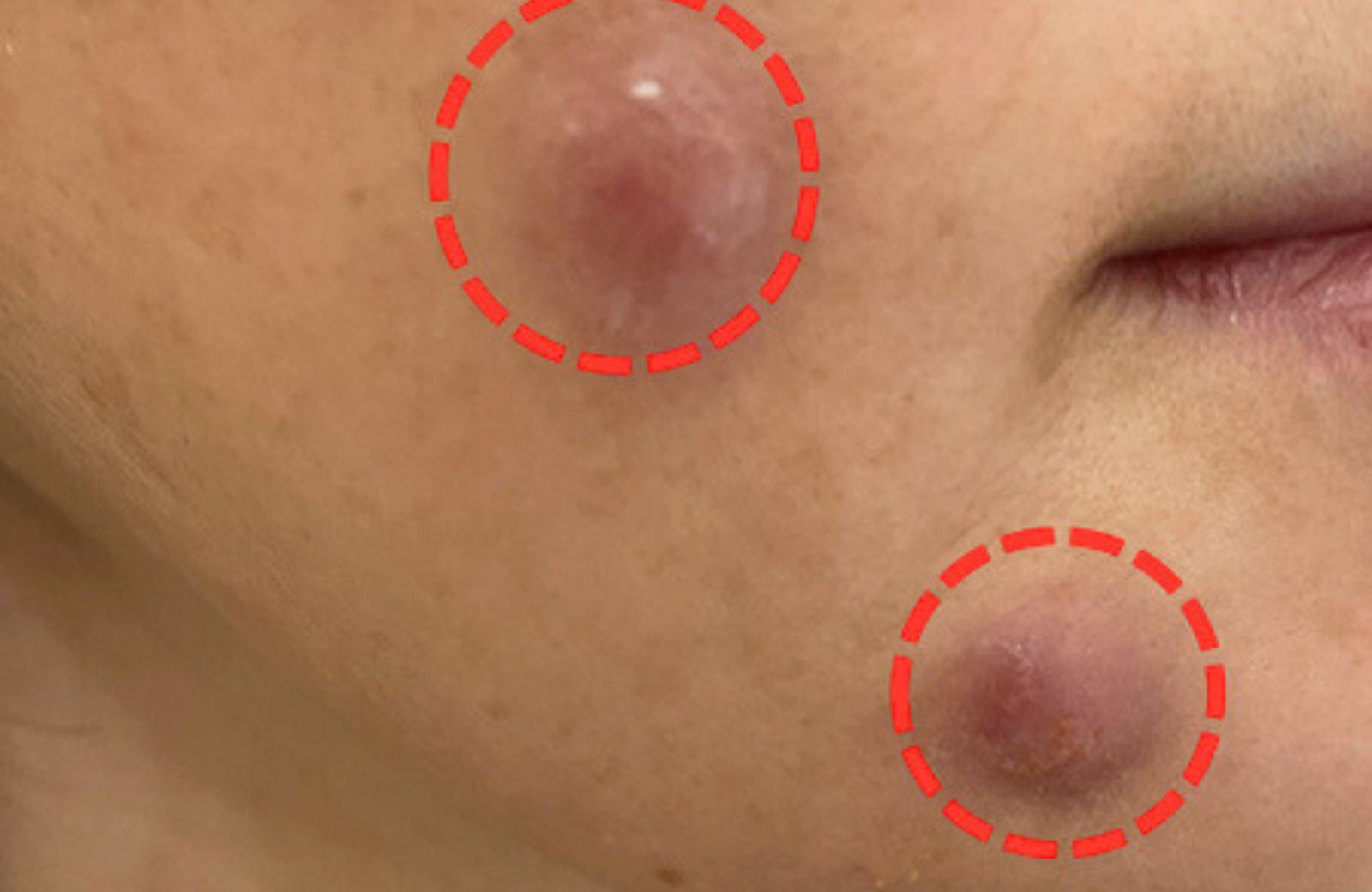 Thread Lift Infection Risks