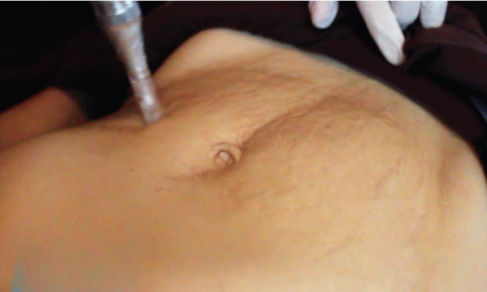 Microneedling for Stretch Marks