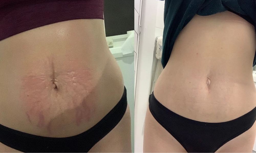 Microneedling for Stretch Marks