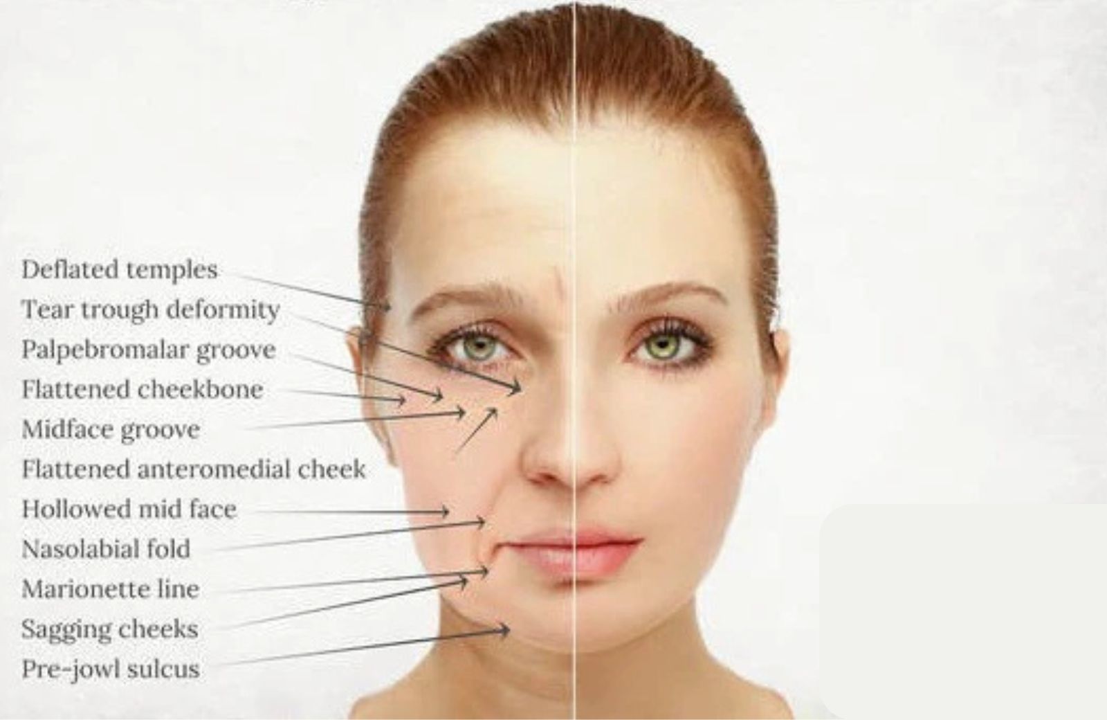 Filling Nasolabial Folds