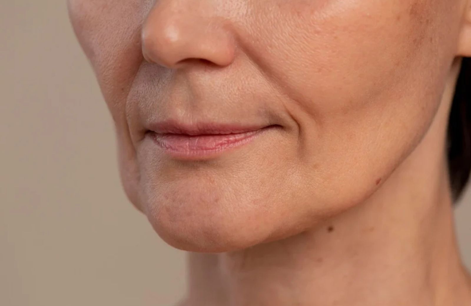 Nasolabial Folds