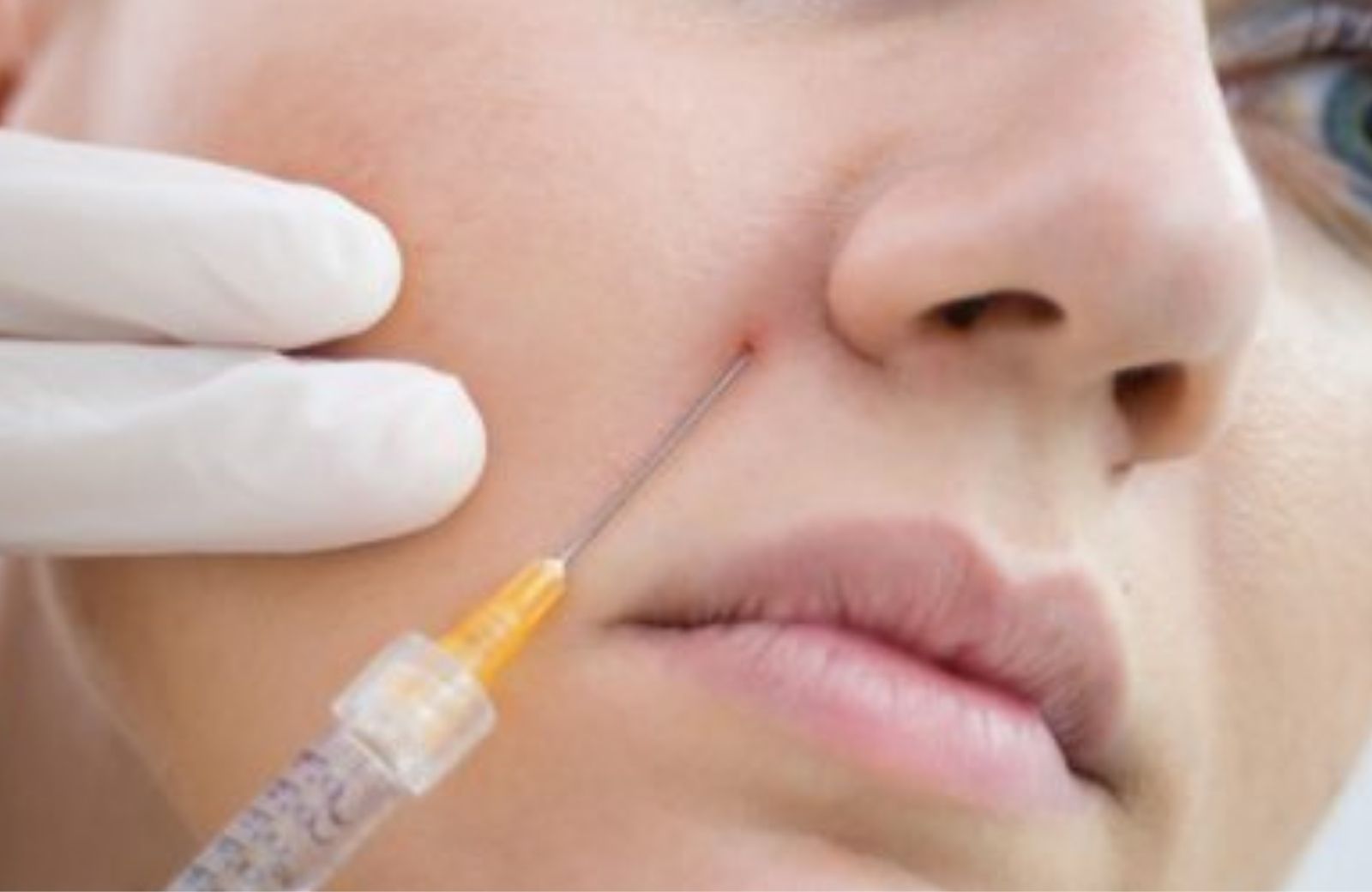 Filler in Nasolabial Folds