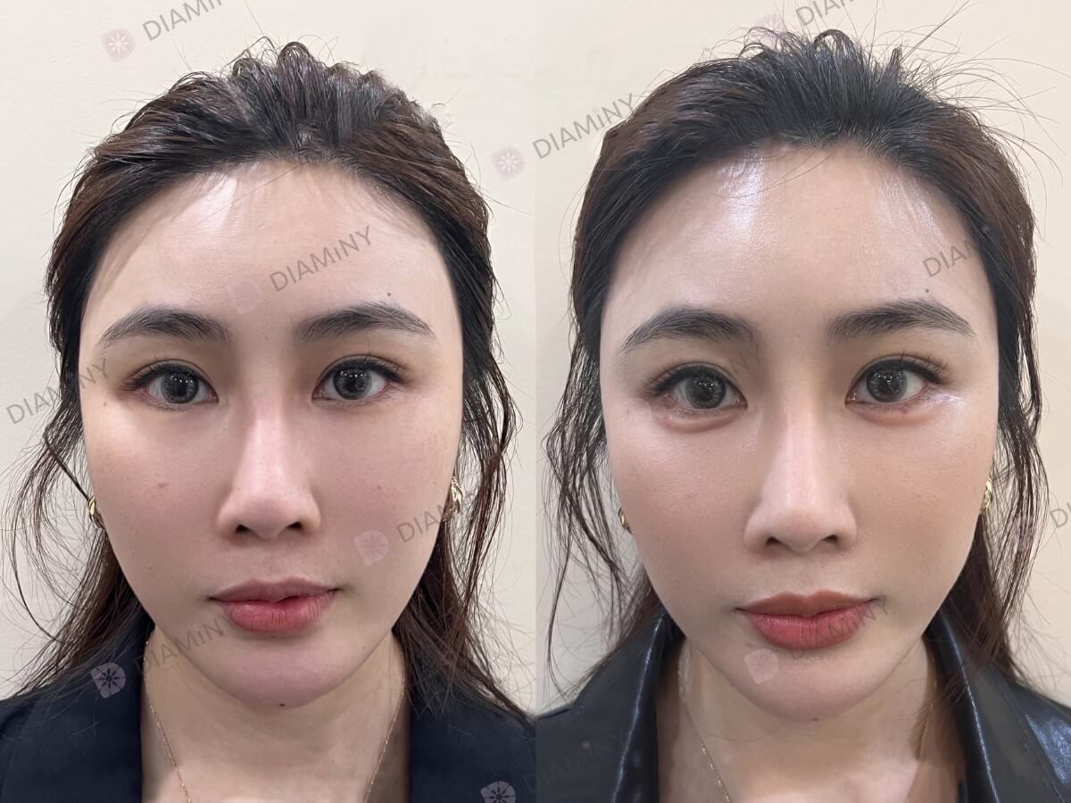Diaminy Under Eye Threads Before and After