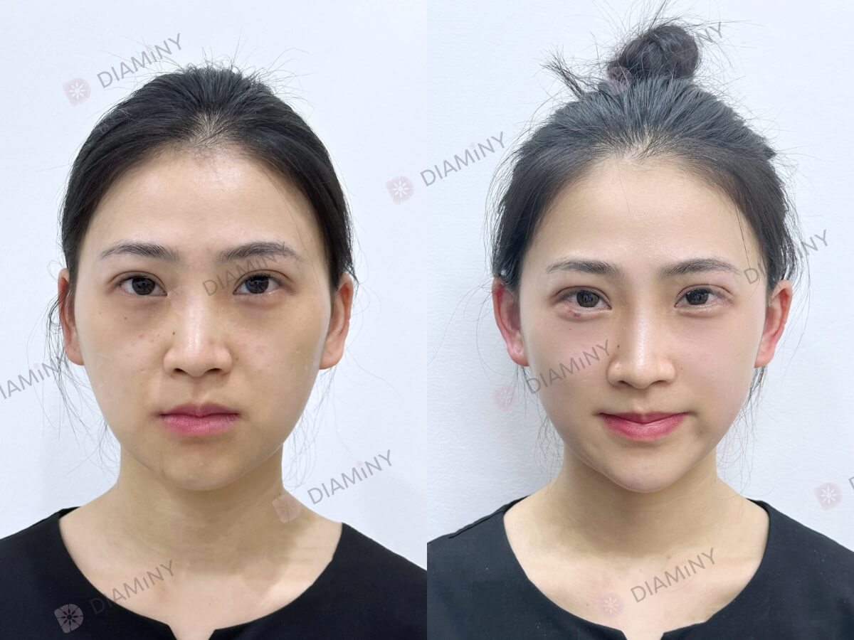 Diaminy Under Eye Threads Lift Before and After