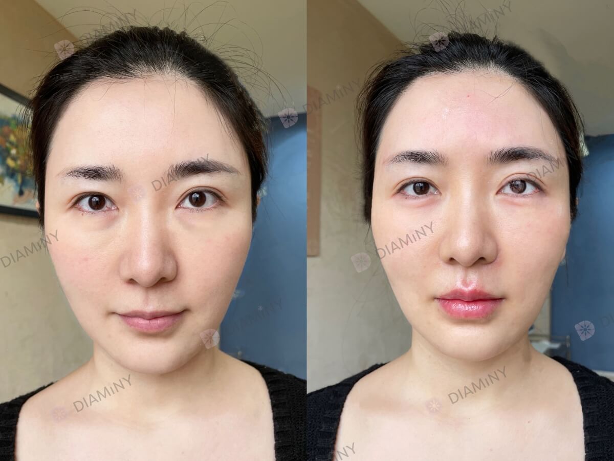 Under Eye Threads Before and After with Diaminy Eye threads