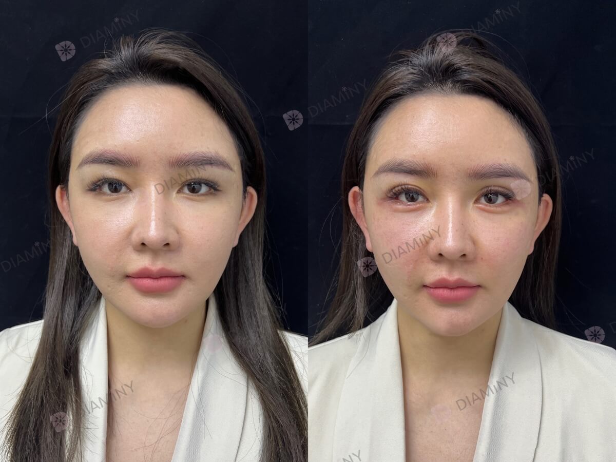 Under Eye Threads Before and After