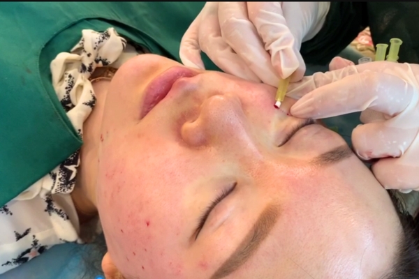 Under Eye thread lift with Diaminy Eye threads