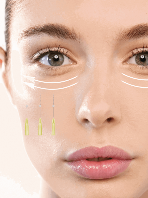 PDO Eye threads