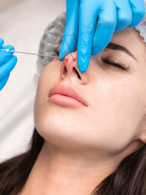 Yastrid PDO nose thread lift