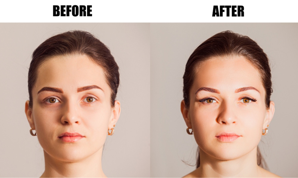 brow lift before and after