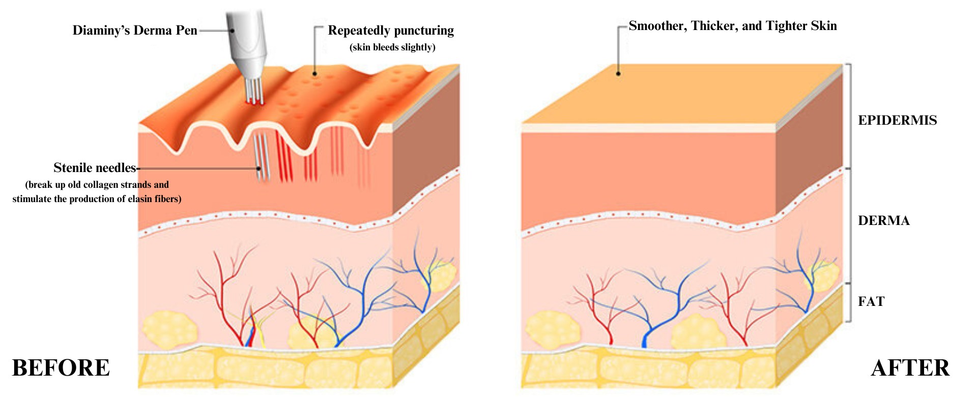 Collagen Induction Therapy (CIT)