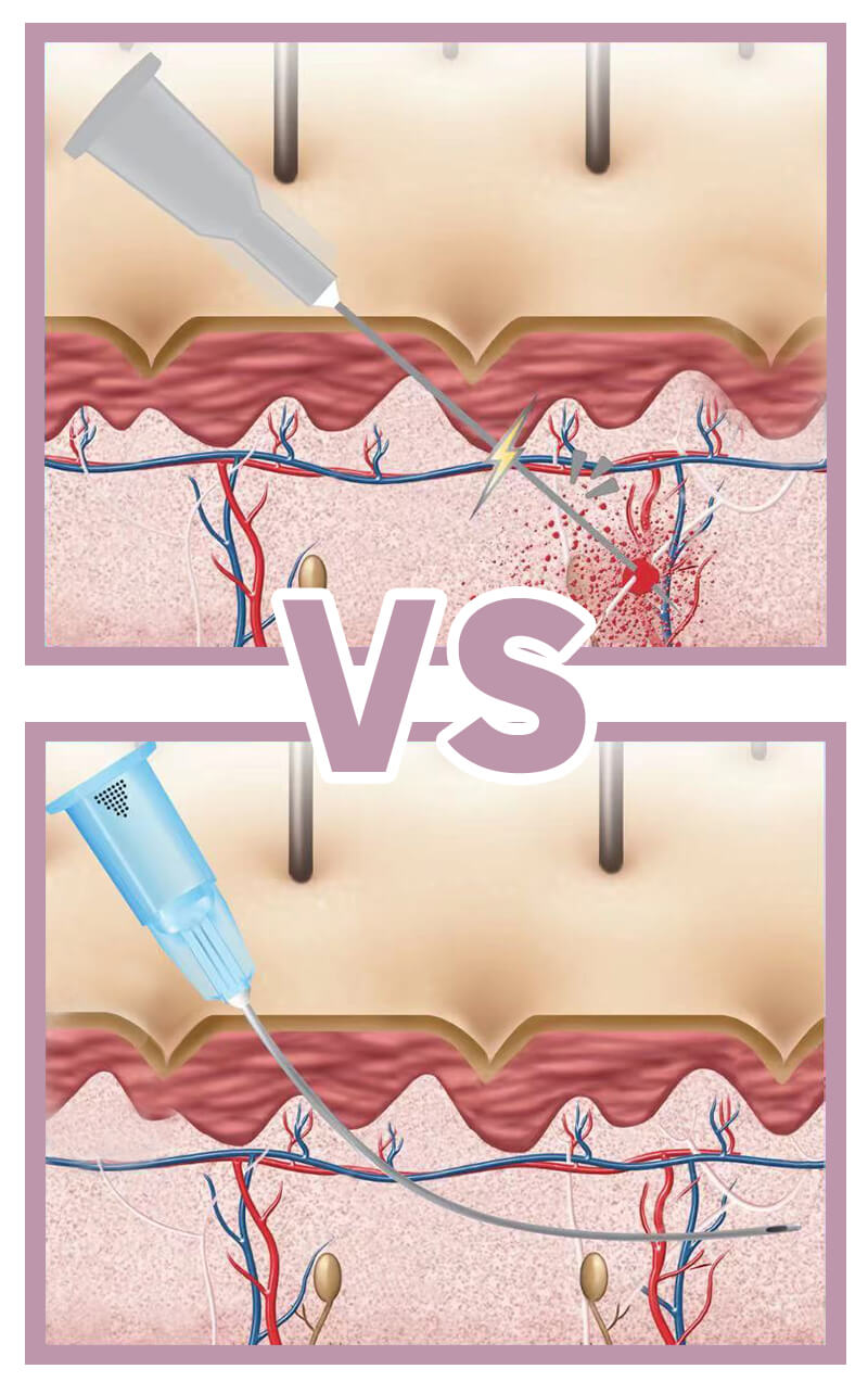 Diaminy Blunt Cannula VS Needle