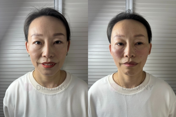 Diaminy Cheek Lift Before and After
