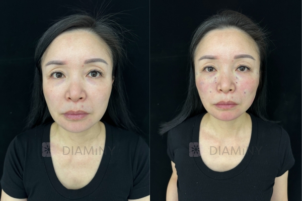 Diaminy Cog Thread Lift Before and After