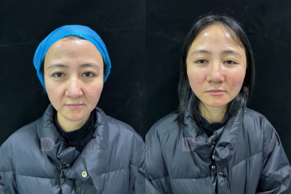 Diaminy Cog Thread Lift for cheek Before and After