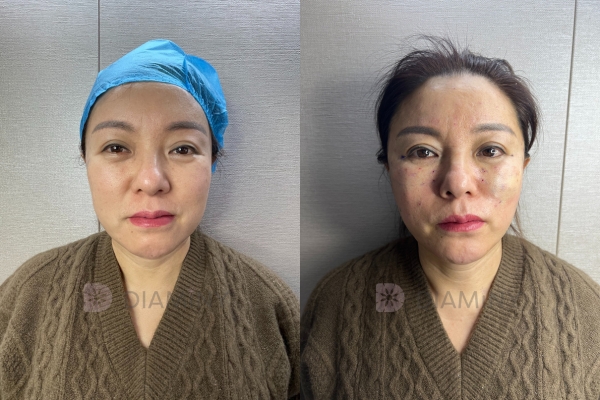 Diaminy PDO Cheek Thread lift Before and After