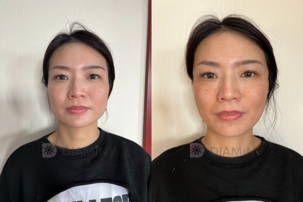 Diaminy PDO Cog Thread cheek Before and After