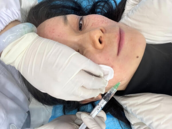 Diaminy meso needle for skin booster injection