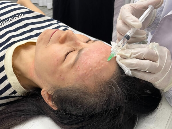SKIN BOOSTER WITH DIAMINY MESO NEEDLE