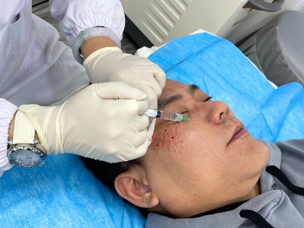 Skin booster injection with Diaminy meso needle