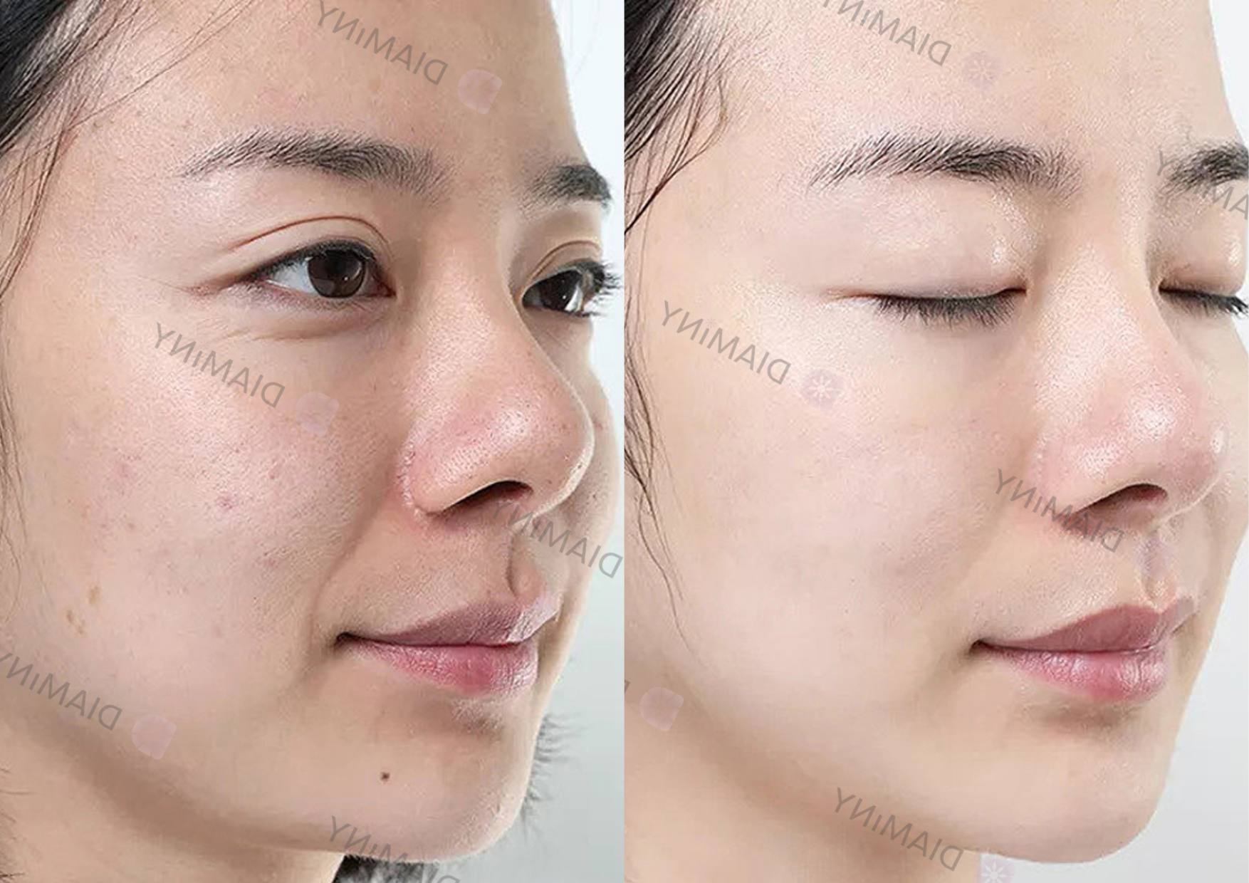 diaminy derma pen before and after
