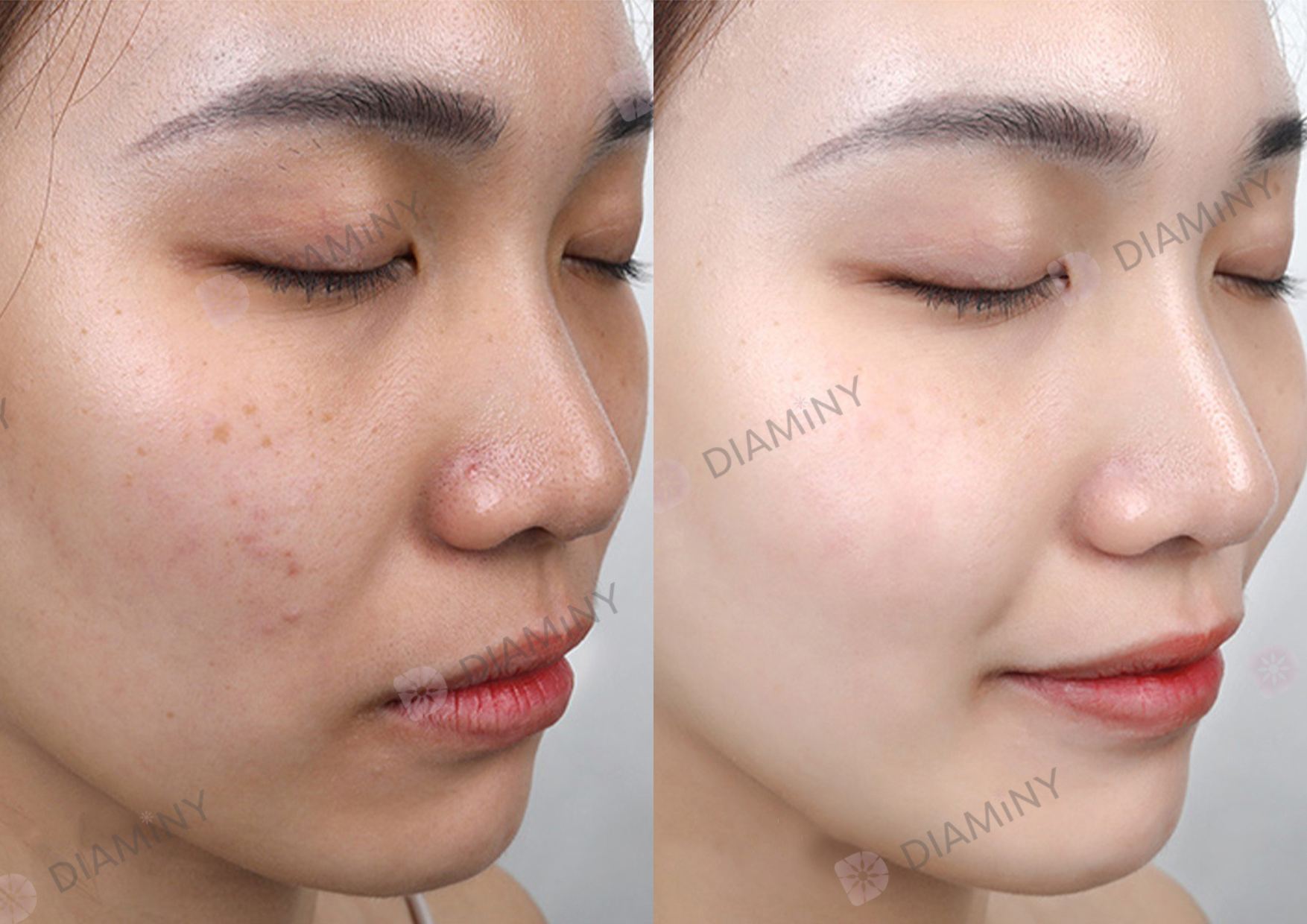 diaminy derma pen before and after