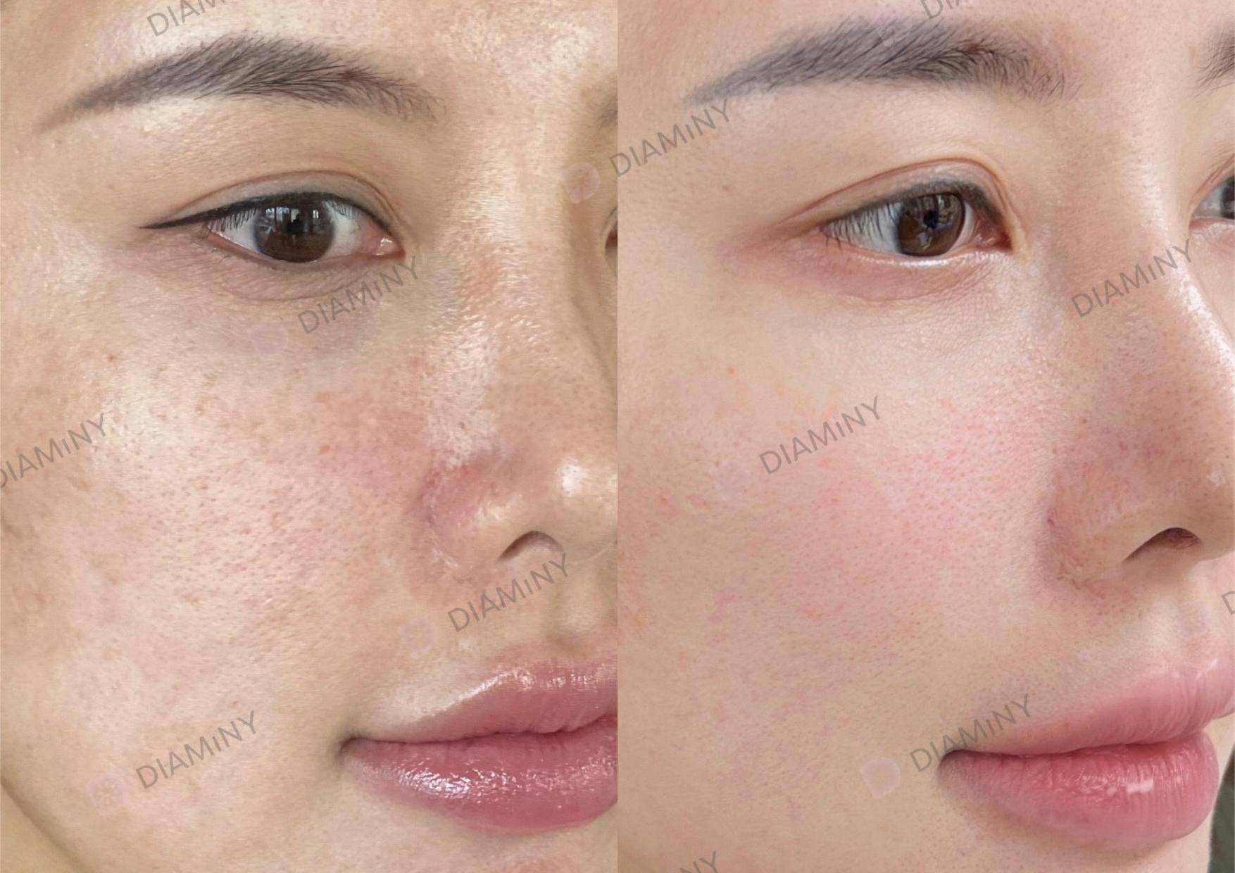 diaminy derma pen before and after