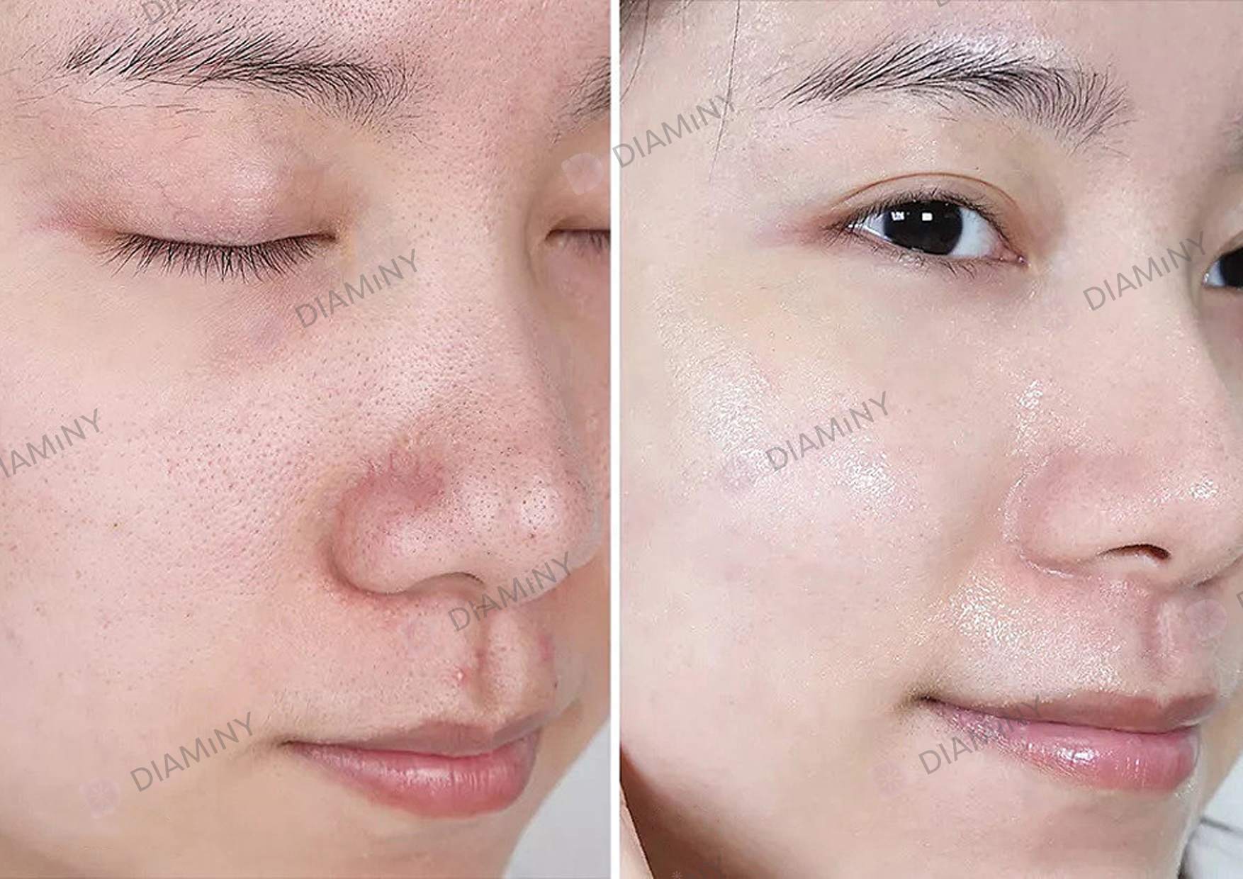 diaminy derma pen before and after