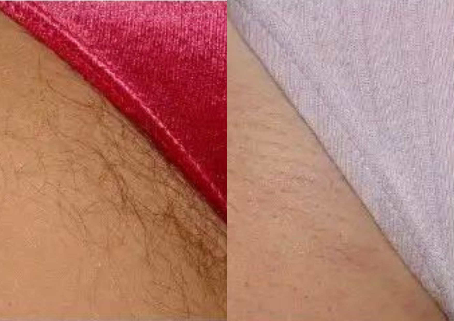 diaminy painless hair removal machine before and after