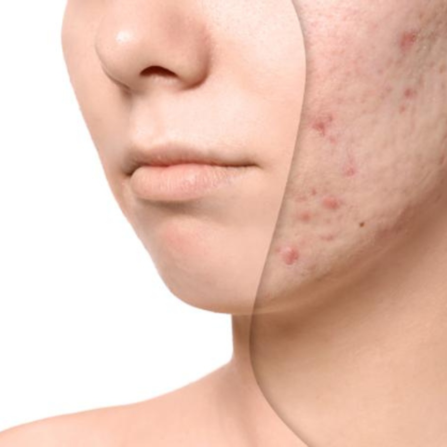 diaminy ipl treatment for acne
