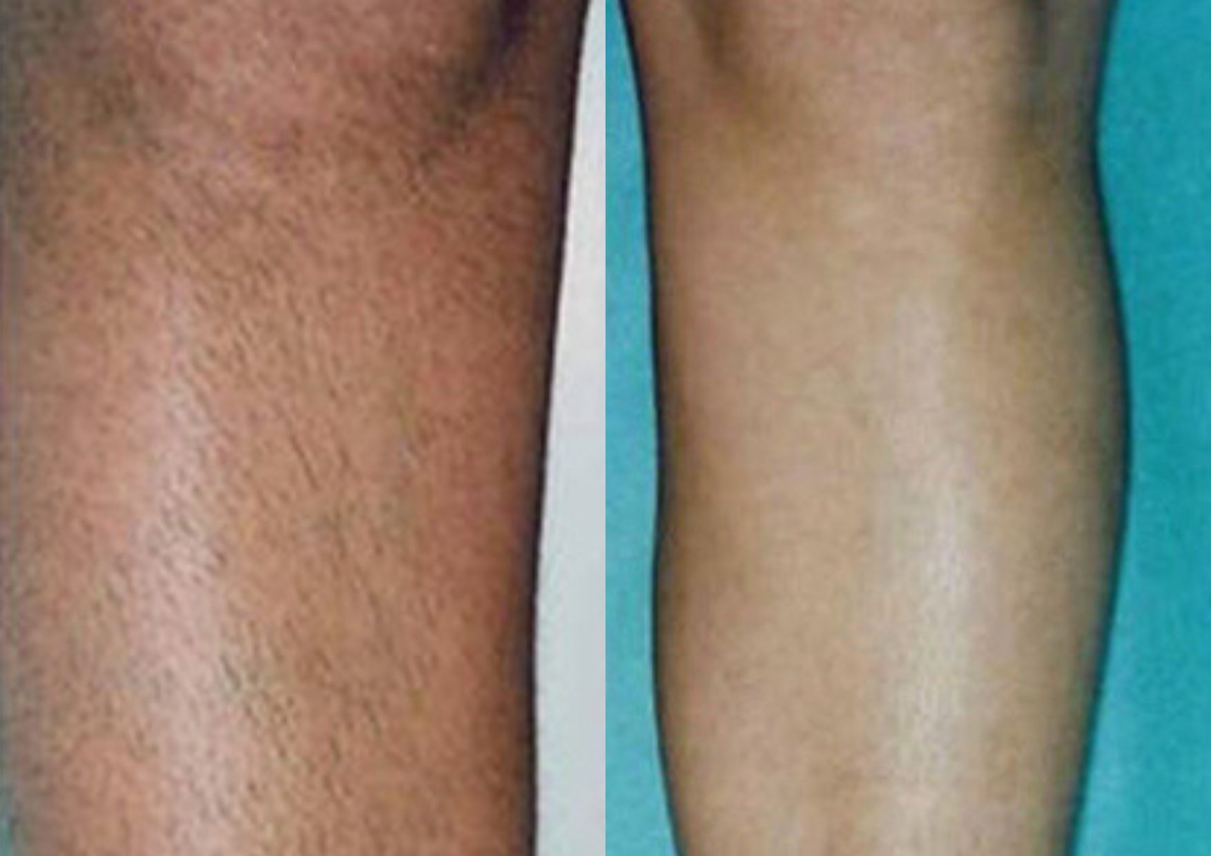 diaminy leg hair removal machine before and after
