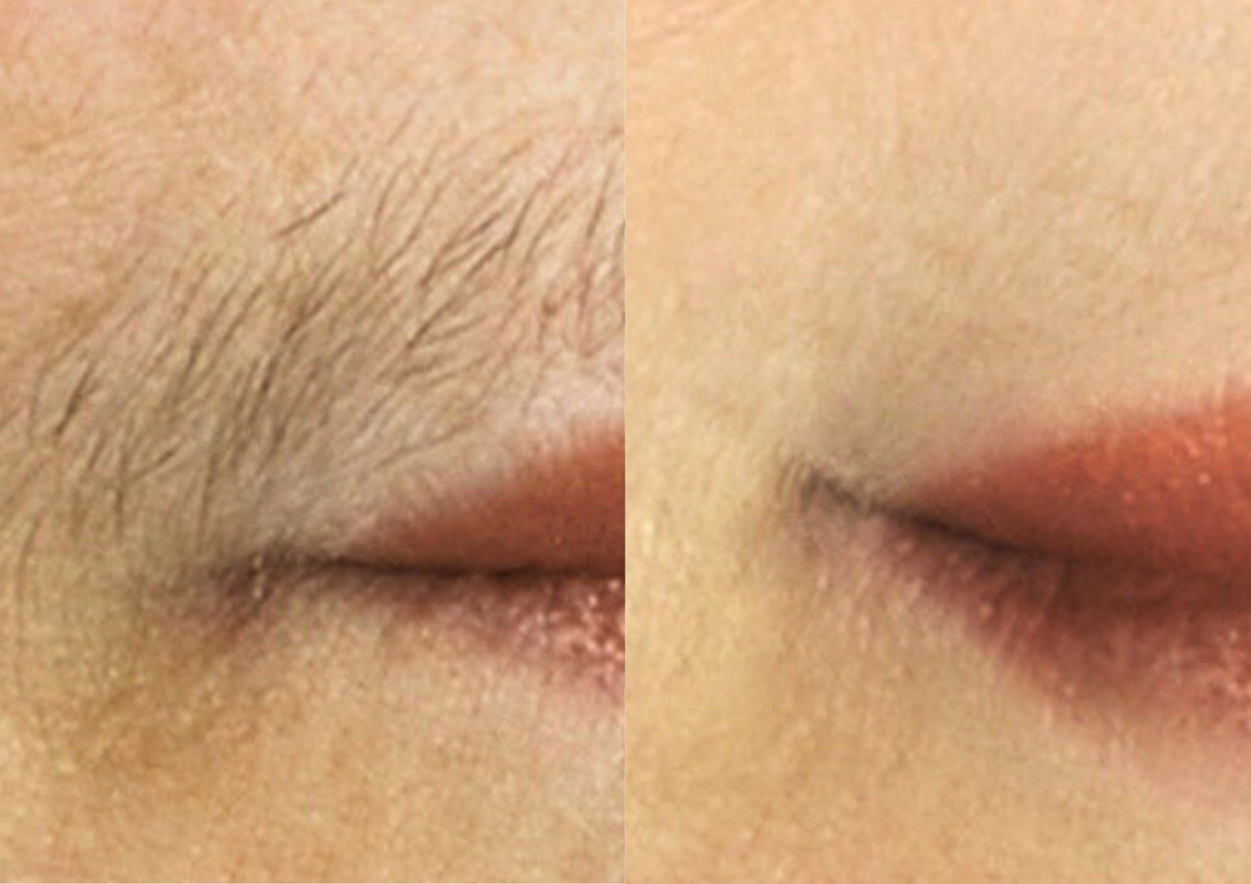 diaminy painless hair removal for face before and after